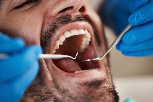 Best Emergency Dentist for Knocked-Out Tooth in South Gate, CA