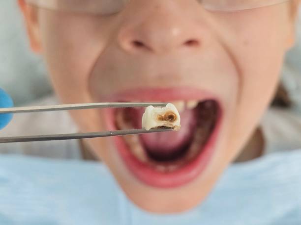 Best Emergency Dental Extractions in South Gate, CA
